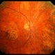 Possible Mellaril Toxicity